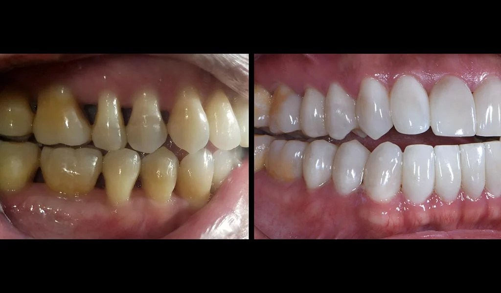 How Bioclear Empowers Dentists To Treat Black Triangles Optident
